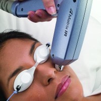 Laser hair removal for facial hair