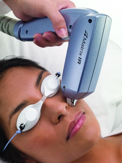 Laser hair removal for facial hair